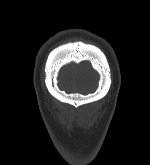 Occipital spur and Currarino type A atlas anomaly (Radiopaedia 87027-103285 Coronal bone window 138).jpg