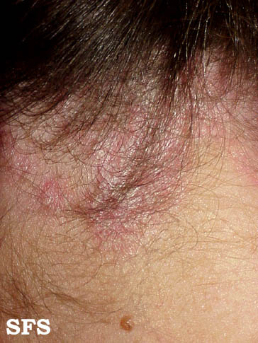 File:Psoriasis (Dermatology Atlas 5).jpg