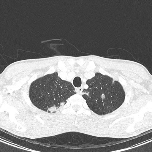 AIDS-related Kaposi sarcoma (Radiopaedia 85247-100811 Axial lung window 23).jpg
