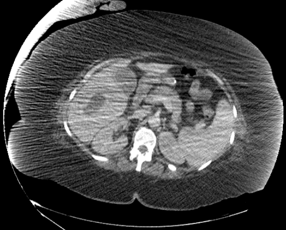 File:Abdominal abscess - pre and post percutaneous drainage (Radiopaedia 60209-67816 Axial 57).png