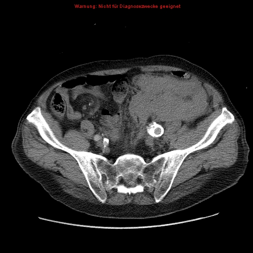 Abdominal aortic aneurysm- extremely large, ruptured (Radiopaedia 19882-19921 Axial C+ arterial phase 59).jpg