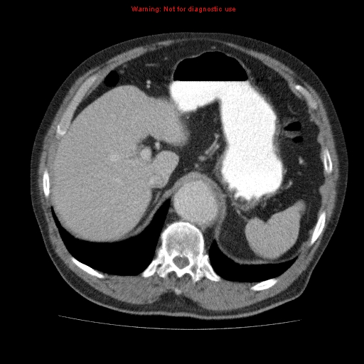 Abdominal aortic aneurysm (Radiopaedia 10122-10660 Axial C+ portal venous phase 16).jpg