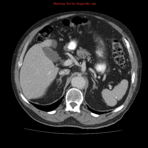 Abdominal aortic aneurysm (Radiopaedia 10122-10660 Axial C+ portal venous phase 20).jpg