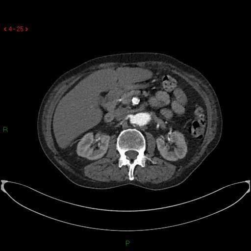 File:Abdominal aortic aneurysm (Radiopaedia 16155-15834 Axial C+ arterial phase 5).jpg