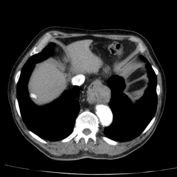 Abdominal aortic aneurysm (Radiopaedia 29248-29660 Axial C+ arterial phase 8).jpg