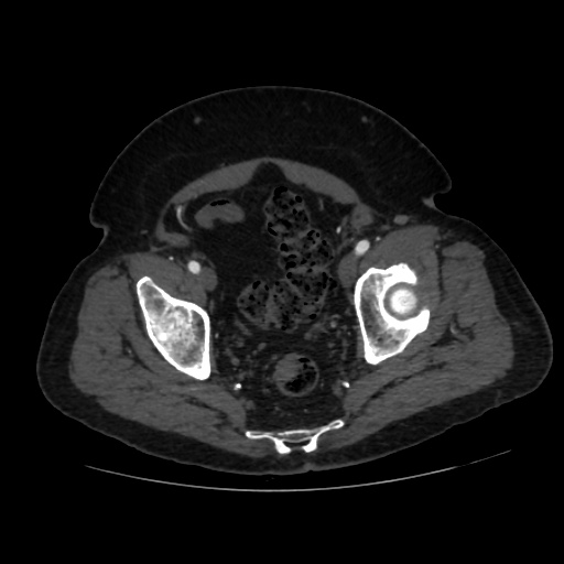 File:Abdominal aortic aneurysm (Radiopaedia 57318-64259 Axial C+ arterial phase 67).jpg