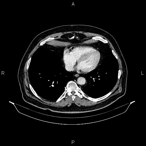 File:Abdominal aortic aneurysm (Radiopaedia 83094-97462 Axial renal cortical phase 54).jpg