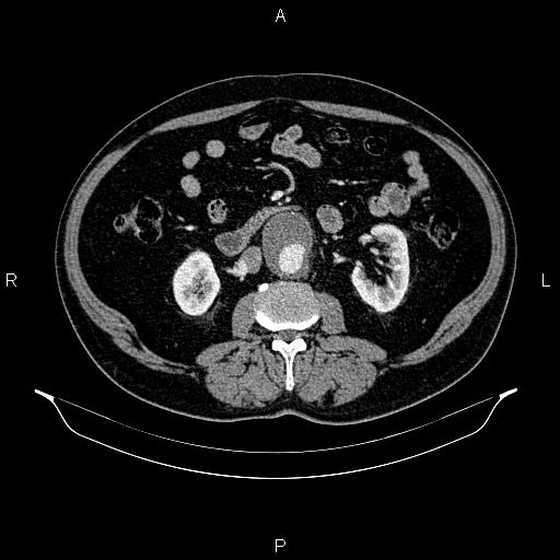 File:Abdominal aortic aneurysm (Radiopaedia 83094-97462 Axial renal cortical phase 97).jpg