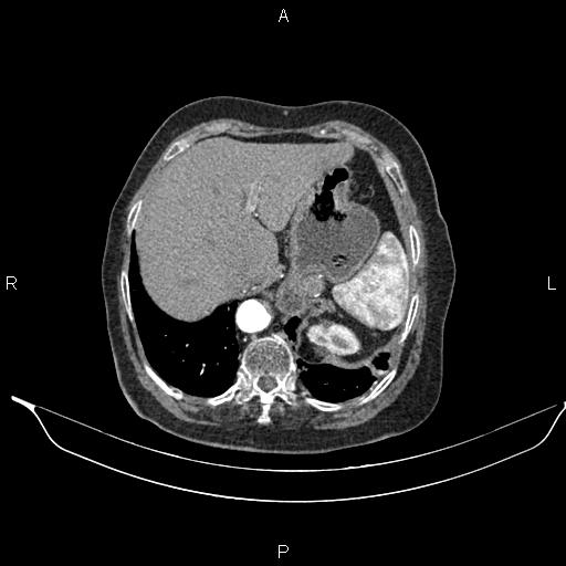 File:Abdominal aortic aneurysm (Radiopaedia 85063-100606 Axial C+ arterial phase 29).jpg