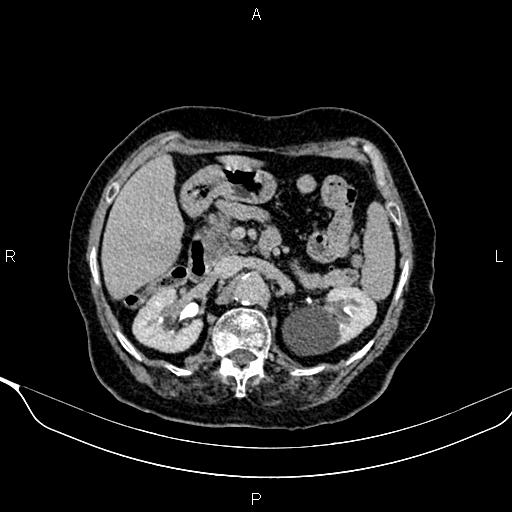 Abdominal aortic aneurysm (Radiopaedia 85063-100606 Axial C+ delayed 32).jpg