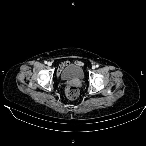 File:Abdominal aortic aneurysm (Radiopaedia 85063-100606 Axial C+ portal venous phase 62).jpg