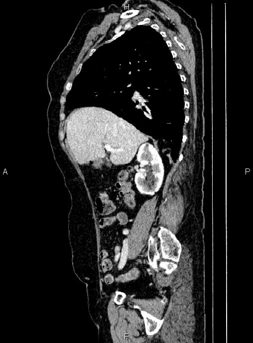 Abdominal aortic aneurysm (Radiopaedia 85063-100606 Sagittal C+ arterial phase 25).jpg