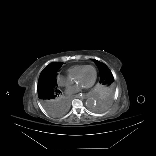File:Abdominal aortic aneurysm - impending rupture (Radiopaedia 19233-19247 Axial non-contrast 18).jpg