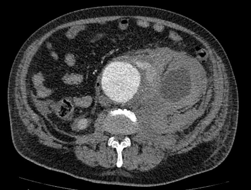 Abdominal aortic aneurysm rupture (Radiopaedia 54179-60362 Axial C+ arterial phase 34).jpg