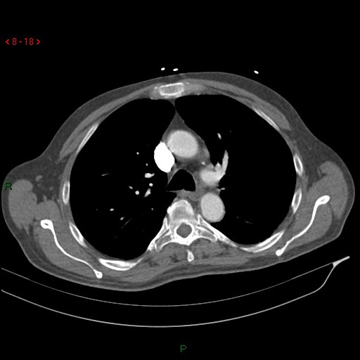 Abdominal aortic aneurysm rupture with aortocaval fistula (Radiopaedia 14897-14841 Axial C+ arterial phase 18).jpg