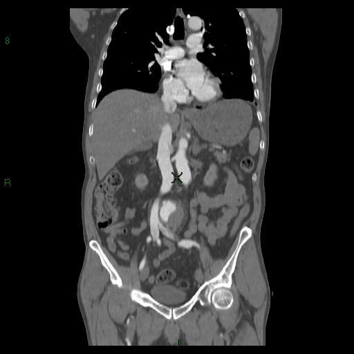 File:Abdominal aortic aneurysm rupture with aortocaval fistula (Radiopaedia 14897-14841 Coronal C+ arterial phase 25).jpg