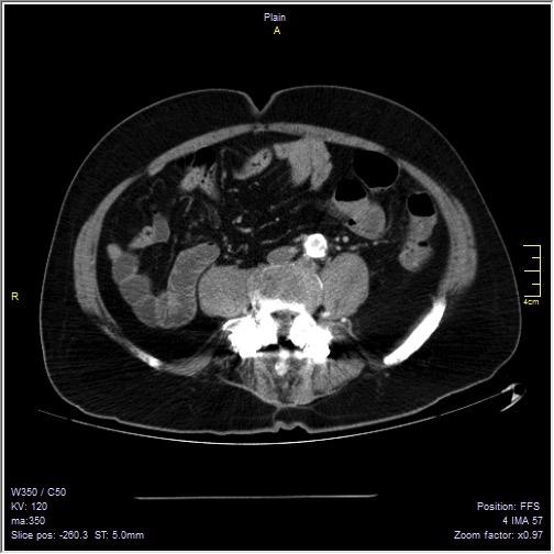 Abdominal aortic aneurysm with thrombus fissuration (Radiopaedia 47340-51926 Axial C+ arterial phase 41).jpg