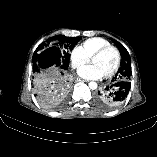 File:Abdominal collection due to previous cecal perforation (Radiopaedia 80831-94320 Axial C+ portal venous phase 1).jpg