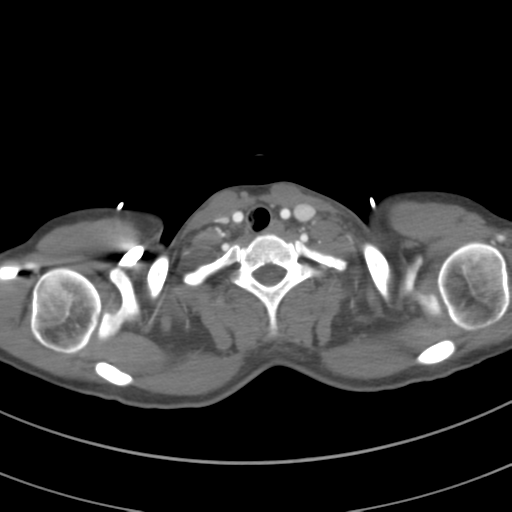 File:Abdominal multi-trauma - devascularised kidney and liver, spleen and pancreatic lacerations (Radiopaedia 34984-36486 Axial C+ arterial phase 7).png
