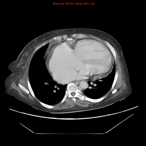 File:Abdominal wall hematoma (Radiopaedia 9427-10112 Axial C+ portal venous phase 6).jpg