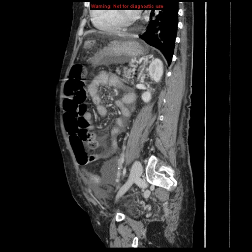 Abdominal wall hematoma (Radiopaedia 9427-10112 Sagittal C+ portal venous phase 38).jpg