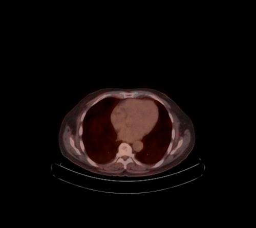 Abdominal wall metastasis from colorectal carcinoma (Radiopaedia 31016-31719 C 101).jpg