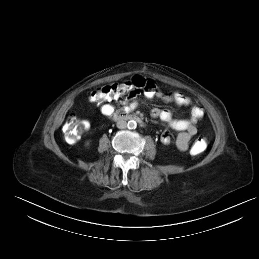 File:Abdominal wall recurrence after colorectal resection for cancer (Radiopaedia 23444-23523 Axial C+ portal venous phase 17).jpg