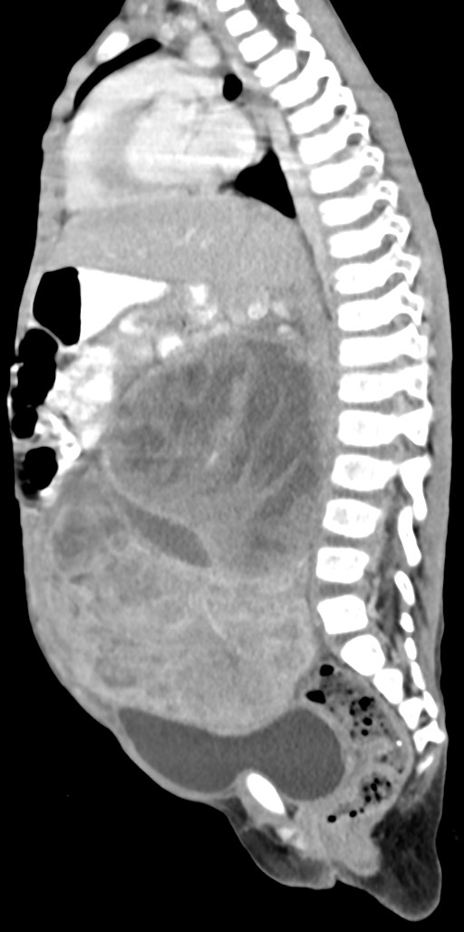 Abdominopelvic rhabdomyosarcoma (Radiopaedia 78356-90984 Sagittal C+ portal venous phase 47).jpg
