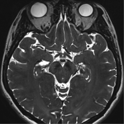 Abducens nerve palsy (Radiopaedia 51069-56648 Axial T2 fat sat 71).png