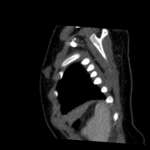 File:Aberrant left pulmonary artery (pulmonary sling) (Radiopaedia 42323-45435 Sagittal C+ arterial phase 51).jpg