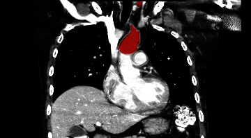 File:Aberrant right subclavian artery (Radiopaedia 9379-38993 Coronal 20).jpg