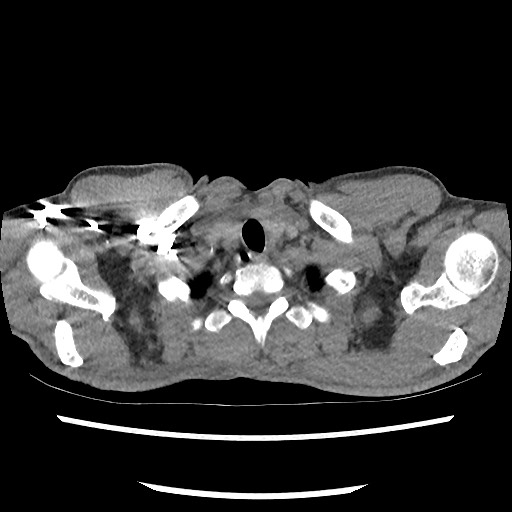 File:Accessory left horizontal fissure with lingular pneumonia (Radiopaedia 53763-59843 Axial C+ CTPA 8).jpg