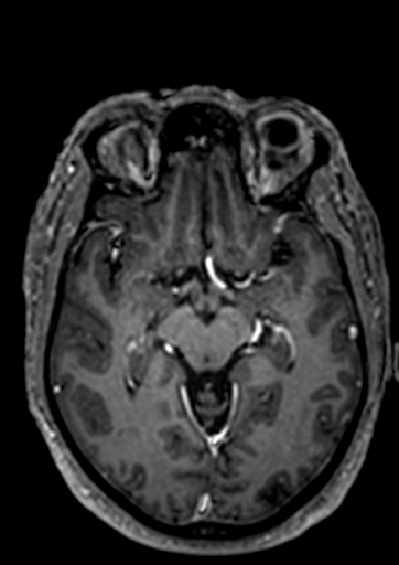 Accessory middle cerebral artery (Radiopaedia 73114-83828 Axial T1 C+ 63).jpg