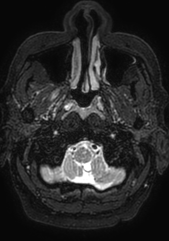 Accessory middle cerebral artery (Radiopaedia 73114-83828 Axial T2 216).jpg