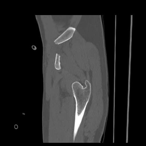Acetabular and ilial fractures (Radiopaedia 59084-66378 Sagittal bone window 12).jpg
