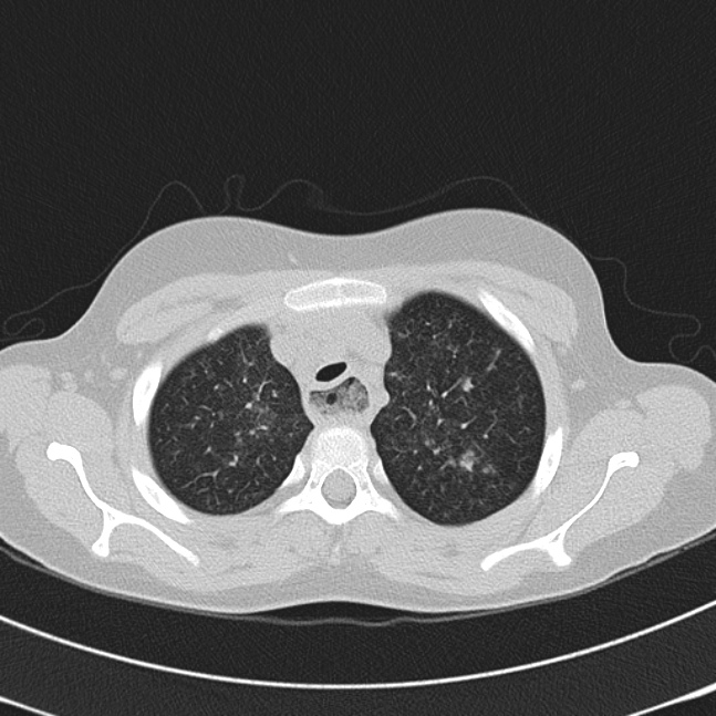 Achalasia (Radiopaedia 14946-14878 Axial lung window 12).jpg