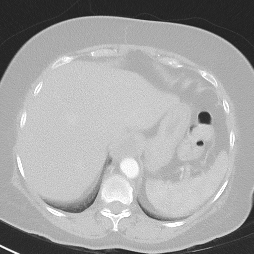 File:Achalasia (Radiopaedia 47147-51685 Axial lung window 43).png