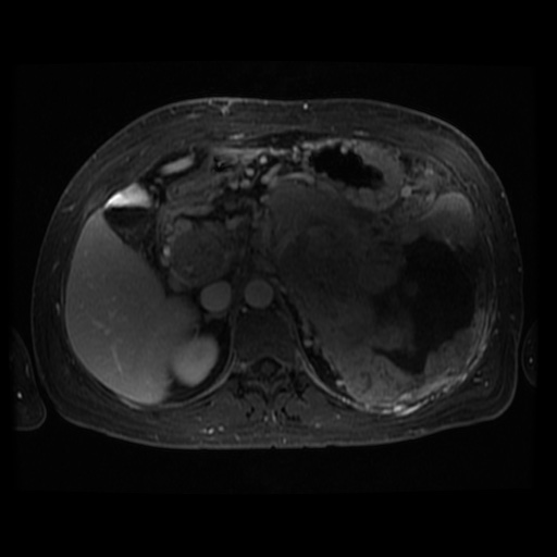 Acinar cell carcinoma of the pancreas (Radiopaedia 75442-86668 D 73).jpg