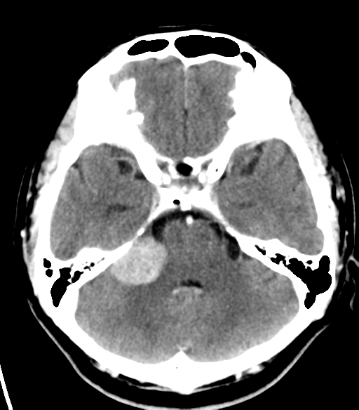 File:Acoustic schwannoma (Radiopaedia 33045-34065 Axial C+ delayed 7).png