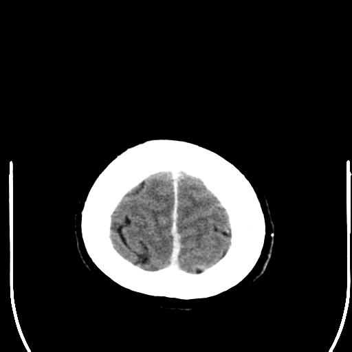 File:Acoustic schwannoma (Radiopaedia 39170-41389 Axial C+ 27).png