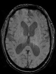 File:Acoustic schwannoma (Radiopaedia 55729-62281 Axial SWI 28).png