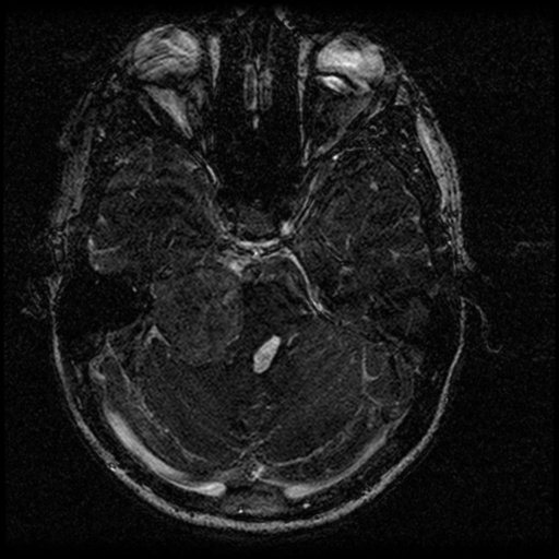Acoustic schwannoma - eroding petrous apex (Radiopaedia 39674-42004 Axial T2 59).png
