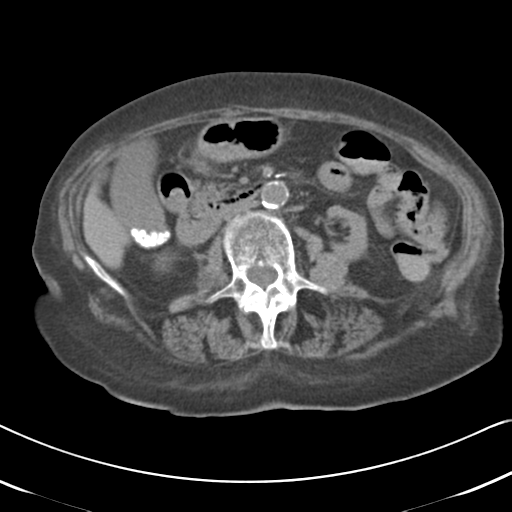 Active bleeding from duodenal ulcer with embolization (Radiopaedia 34216-35481 Axial non-contrast 29).png