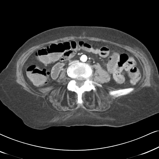 File:Active bleeding from duodenal ulcer with embolization (Radiopaedia 34216-35481 C 36).png
