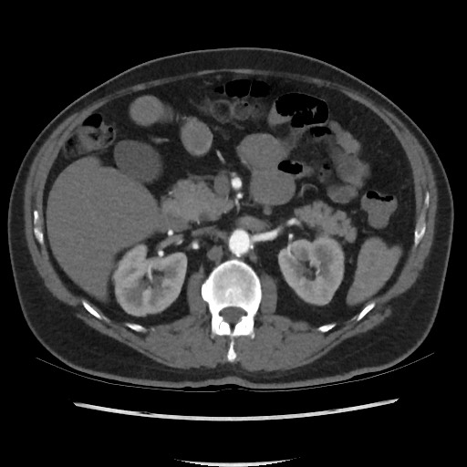 File:Active colonic bleed on CT (Radiopaedia 49765-55025 Axial C+ arterial phase 31).jpg