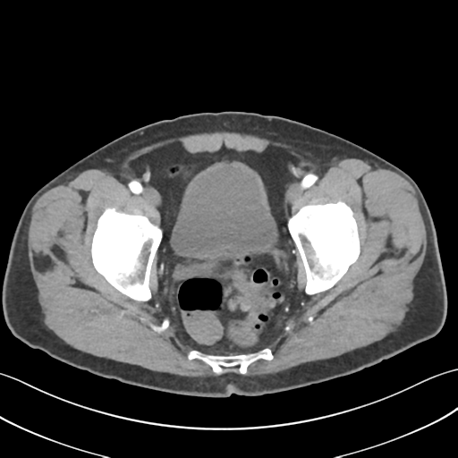 File:Active diverticular hemorrhage (Radiopaedia 39415-41725 Axial C+ arterial phase 63).png