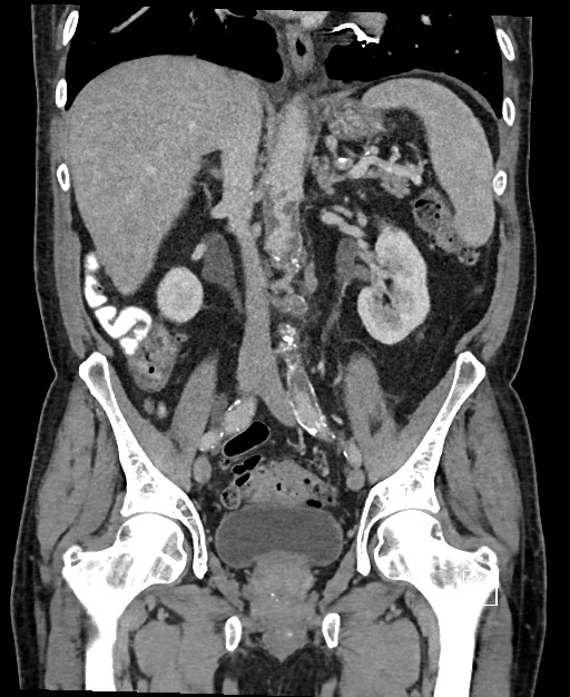 Active lower gastrointestinal bleeding - diverticular (Radiopaedia 61203-69106 Coronal C+ portal venous phase 76).jpg