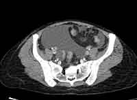 Acute Budd-Chiari syndrome (Radiopaedia 60858-68638 A 235).jpg