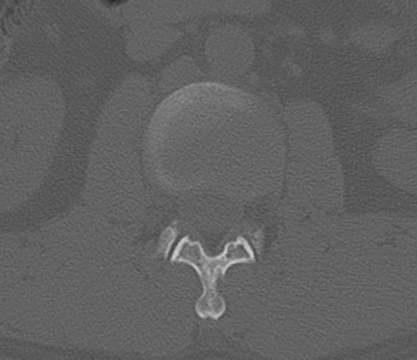File:Acute L1 burst compression fracture (Radiopaedia 34430-35755 Axial bone window 29).png