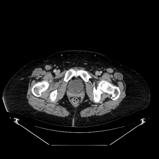 File:Acute appendicitis, heterotaxy syndrome (Radiopaedia 66884-76202 Axial C+ portal venous phase 129).jpg